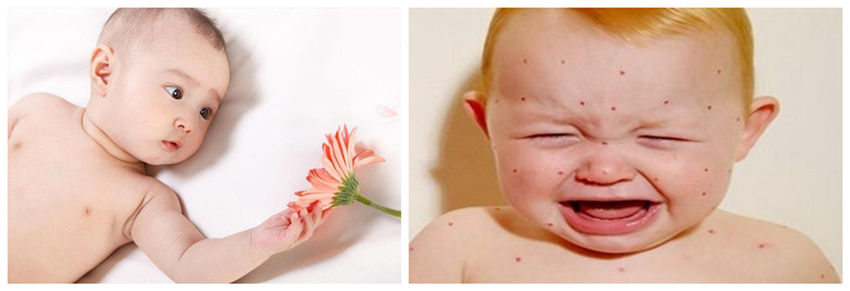 兒童濕疹反反復(fù)復(fù)，您有在家安裝家用除濕產(chǎn)品嗎？